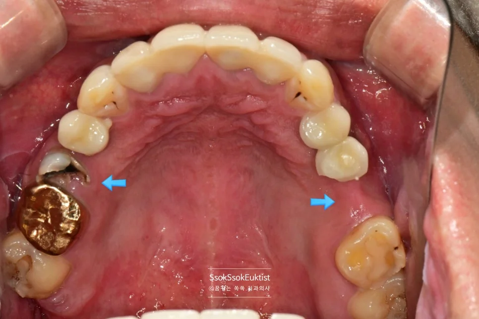 수면 임플란트 치료 전 상악 교합면 사진 양측 손상된 구치부 화살표