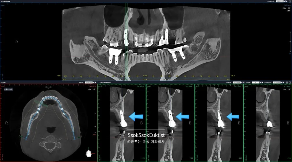 임플란트 주위염 CBCT 단면 영상 주변 골소실 화살표 표시