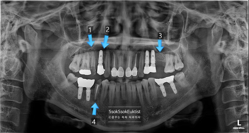 수면 임플란트 CBCT 파노라마 진단 영상 1번 2번 3번 4번 치아 위치 화살표
