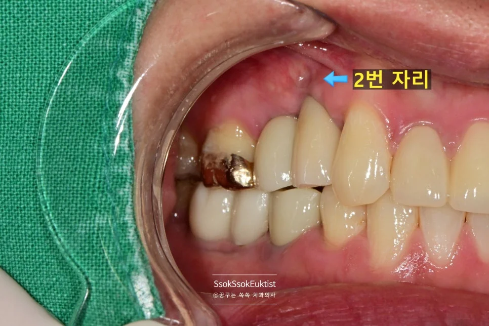 임플란트 치료 1개월 후 2번 자리 잇몸 건강 회복 경과 관찰