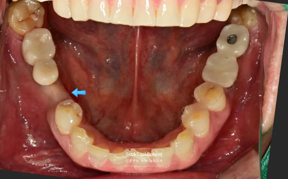 임플란트 식립 후 하악 교합면 잇몸 치유 상태 화살표
