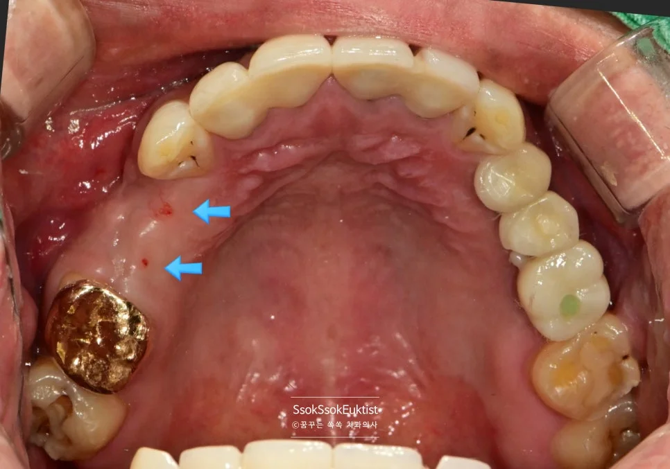 임플란트 식립 후 상악 교합면 잇몸 치유 상태 화살표