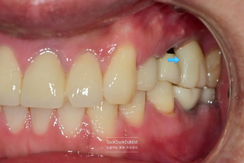 임플란트 보철 완료 좌측 측면 잇몸 치유 상태