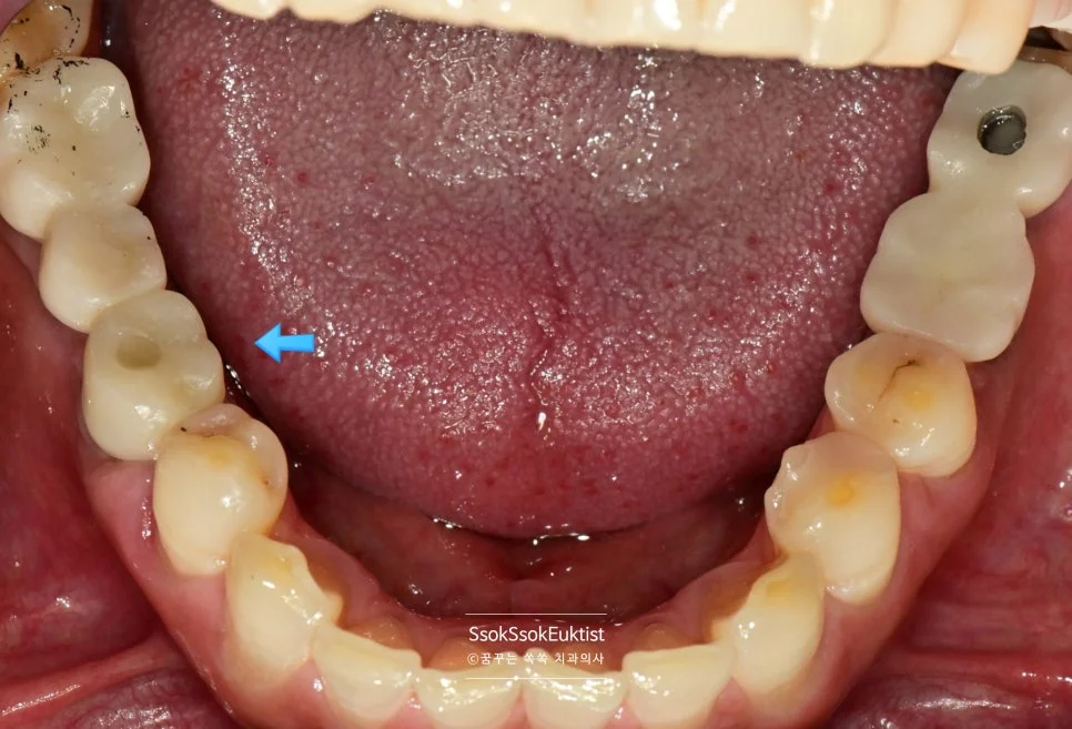 임플란트 보철 완료 하악 교합면 최종 상태 화살표