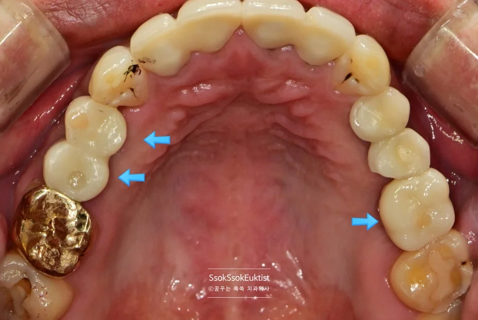 임플란트 보철 완료 상악 교합면 전체 화살표 표시