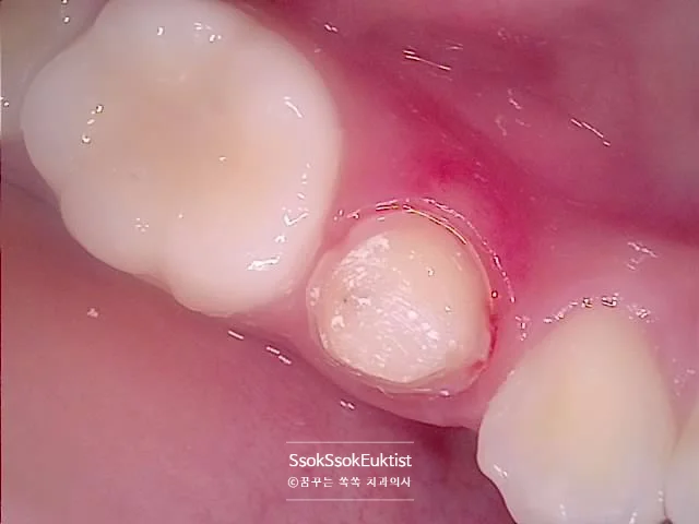 수면 신경치료 증례1 신경조직 노출 임상 사진