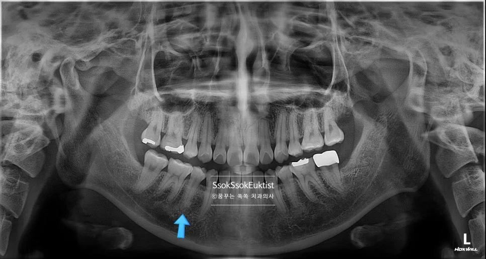 수면 신경치료 증례1 파노라마 X-ray 치외치 화살표 진단
