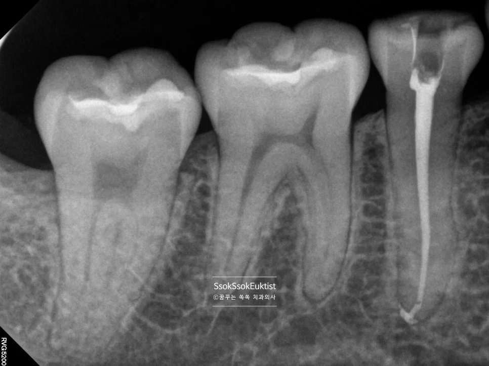 수면 신경치료 증례1 치근단 X-ray 신경관 상태 확인