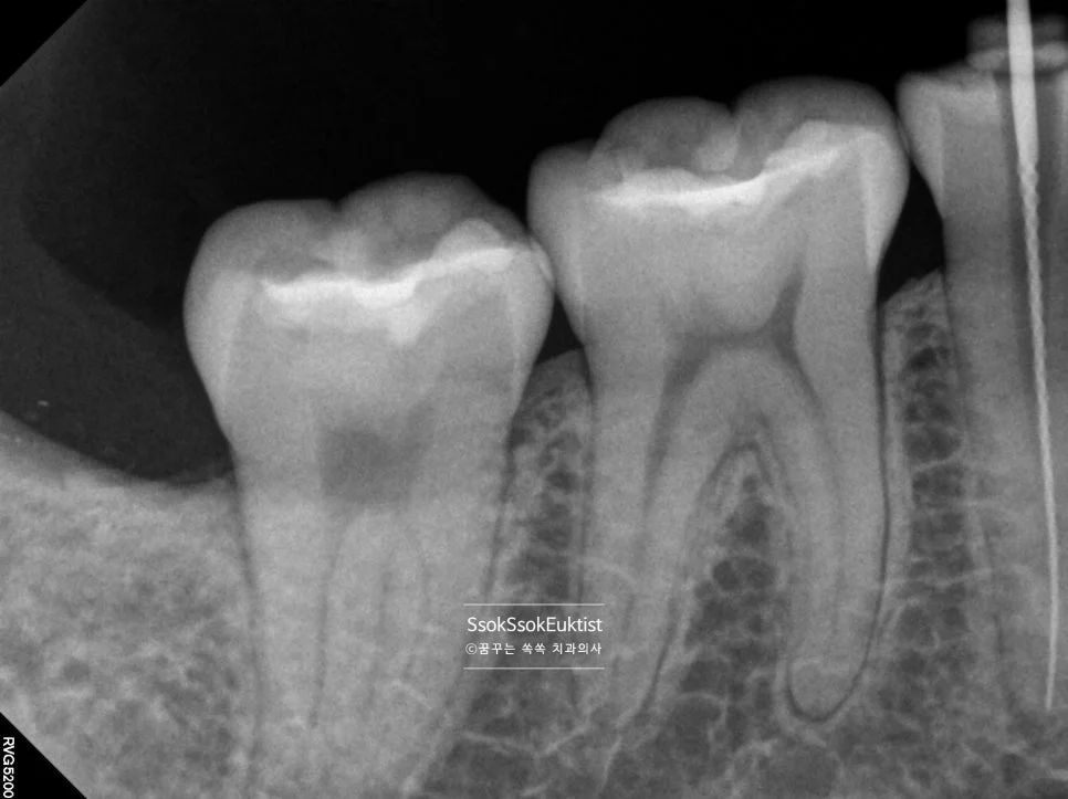 수면 신경치료 증례1 치근단 X-ray 넓은 신경관 치외치