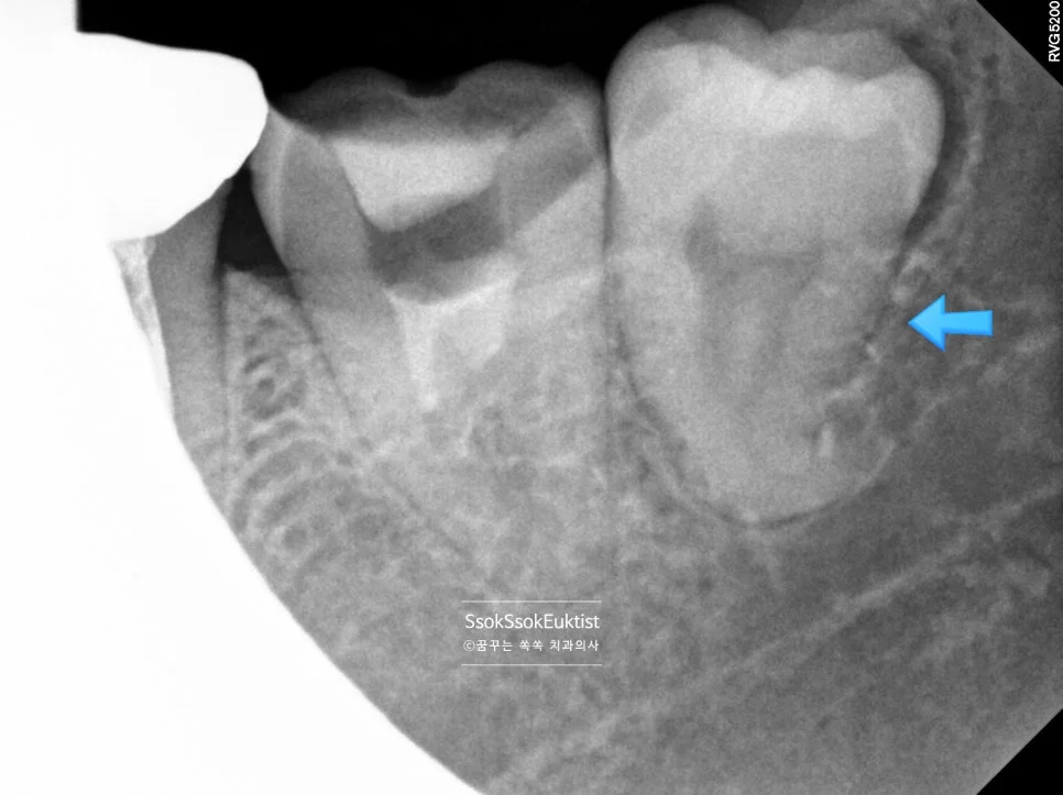 수면 신경치료 증례2 C형근관 측면 X-ray 사랑니 화살표