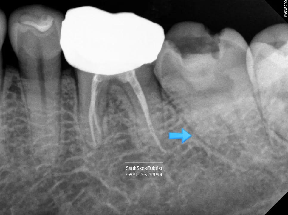 수면 신경치료 증례2 C형근관 치근단 X-ray 화살표