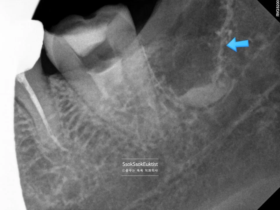 수면 신경치료 증례2 사랑니 발치 부위 X-ray 화살표