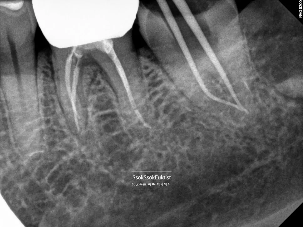 수면 신경치료 증례2 근관충전 재료 확인 X-ray
