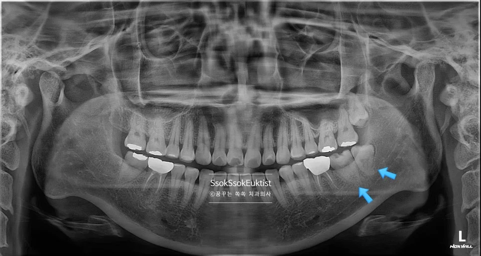 수면 신경치료 증례2 파노라마 X-ray 진단 화살표 C형근관 사랑니