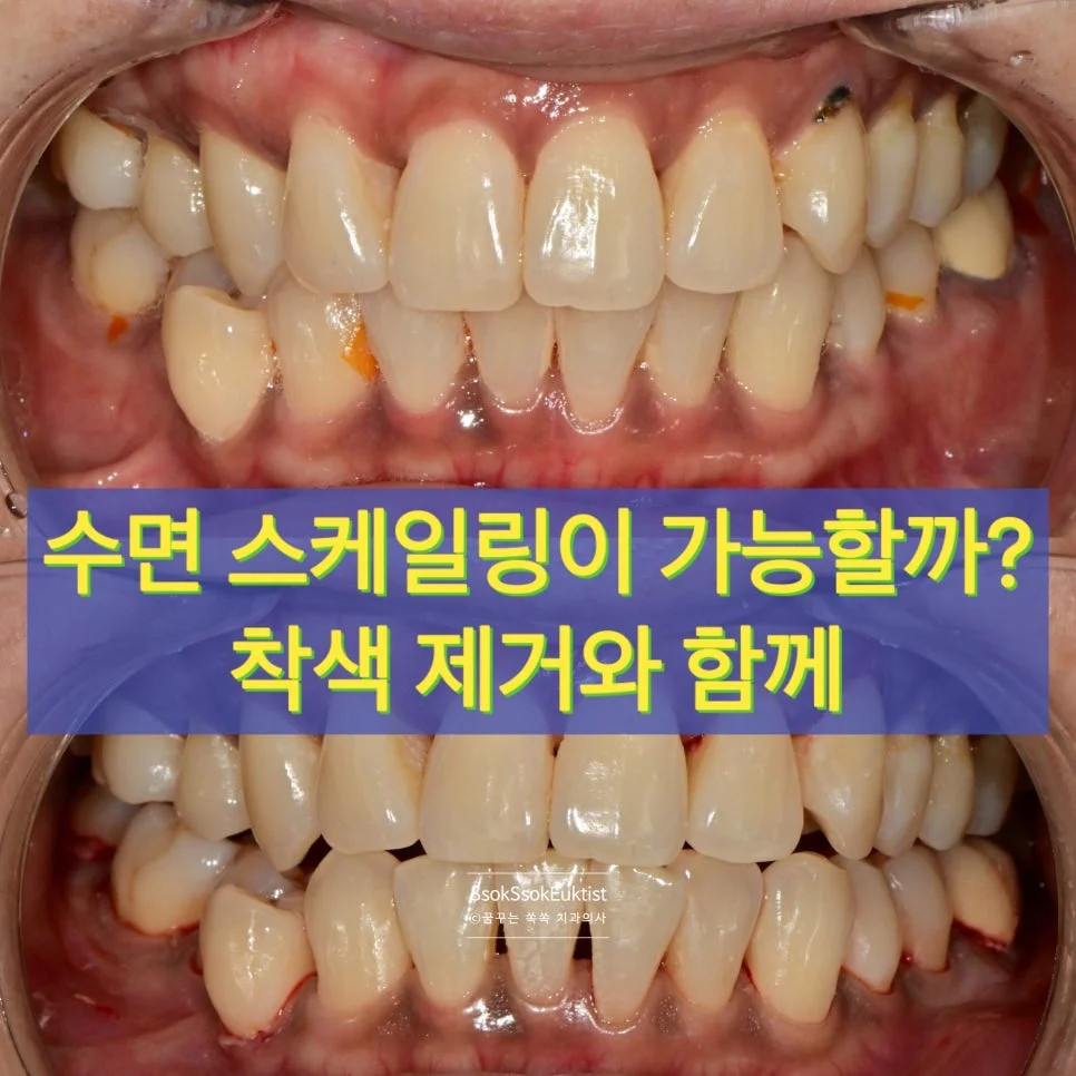 수면 스케일링 전후 비교 구강 사진