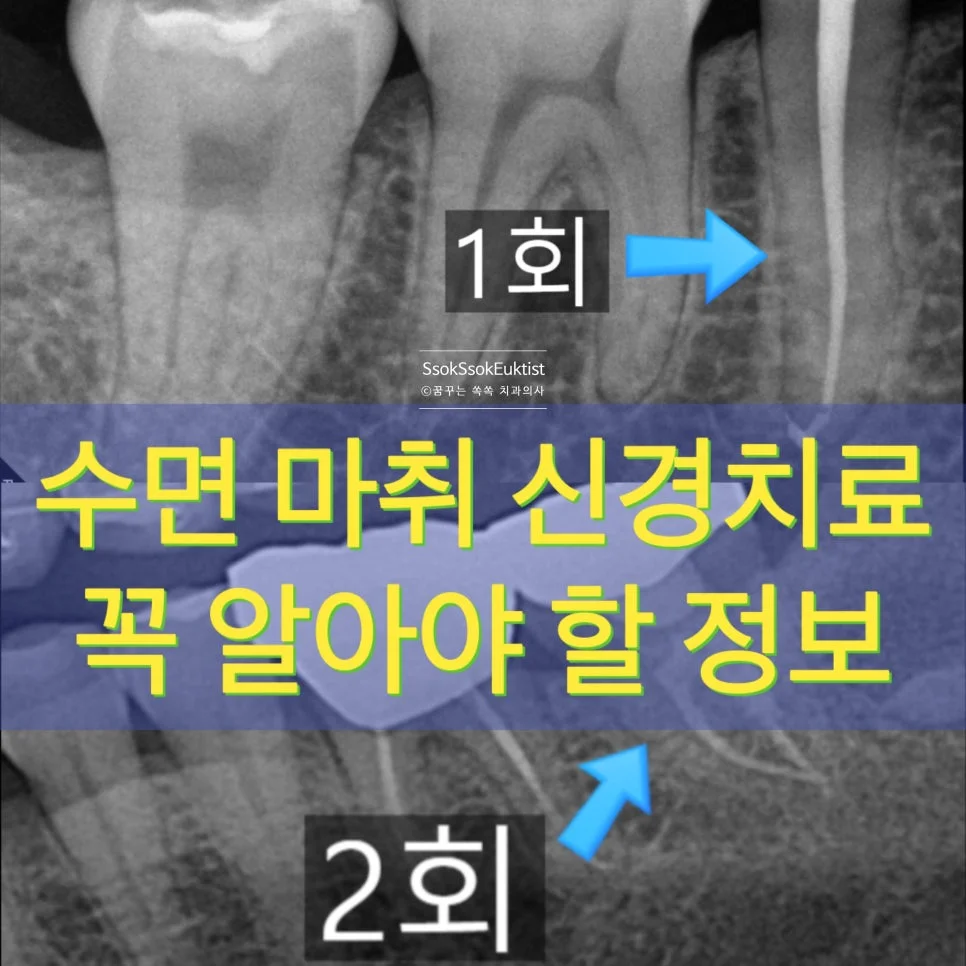 수면 마취 신경치료 진단 X-ray 치외치 원데이 C형근관 2회 치료 개요