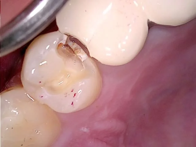 스푼 익스카베이터 치과 기구 사진