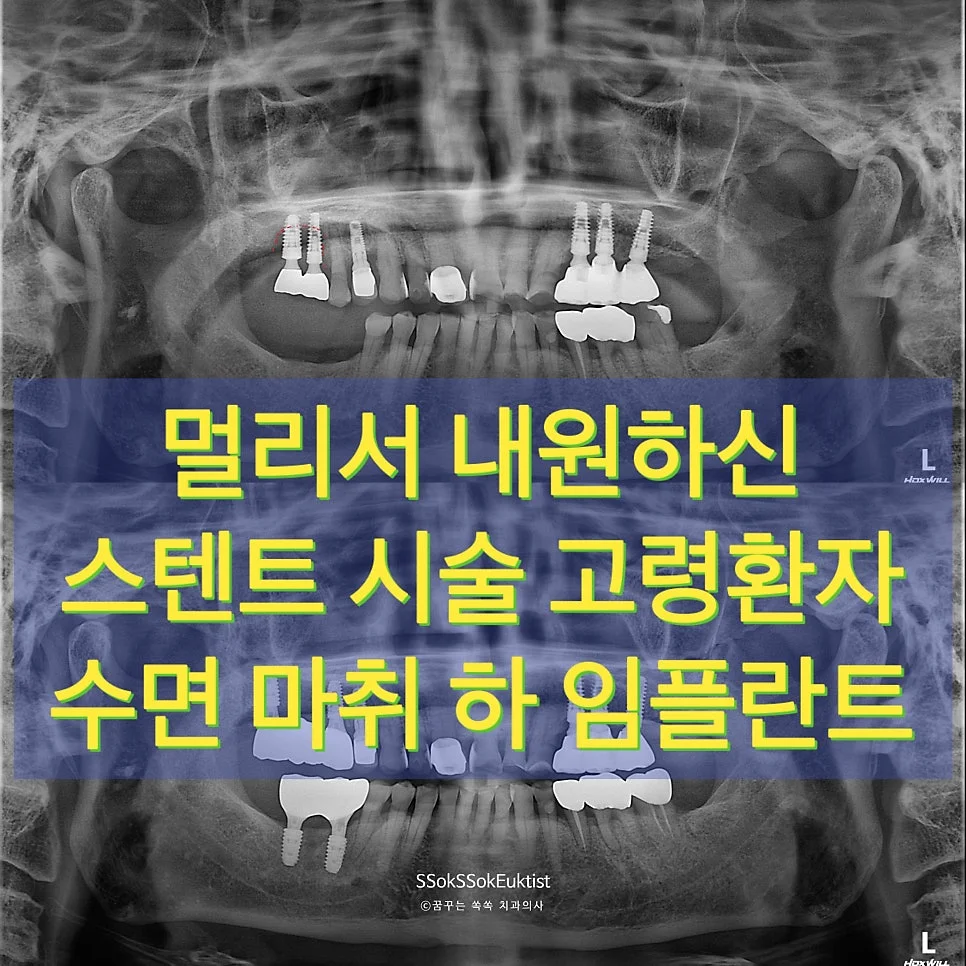 심장 스텐트 환자 파노라마 초기 진단