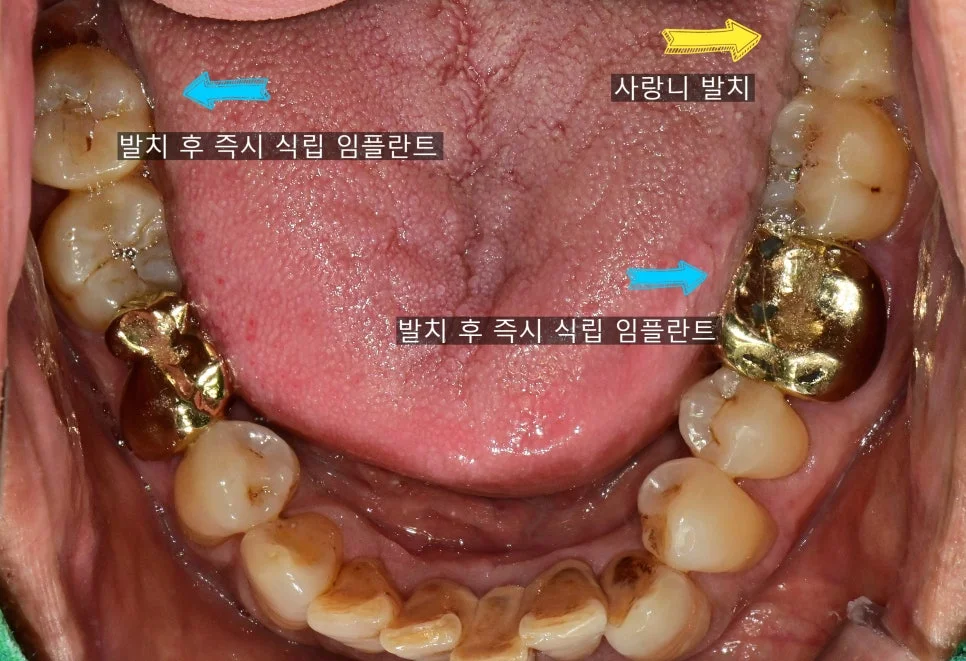 의식하 진정 하 발치 및 뼈이식 수술 과정