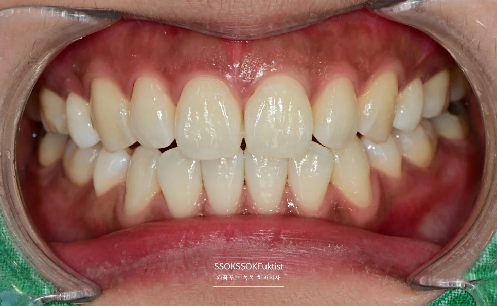 치아 미백 케이스1 미백 후 A1보다 밝은 결과