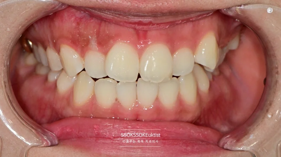 치아 미백 케이스2 미백 후 B1보다 밝은 결과