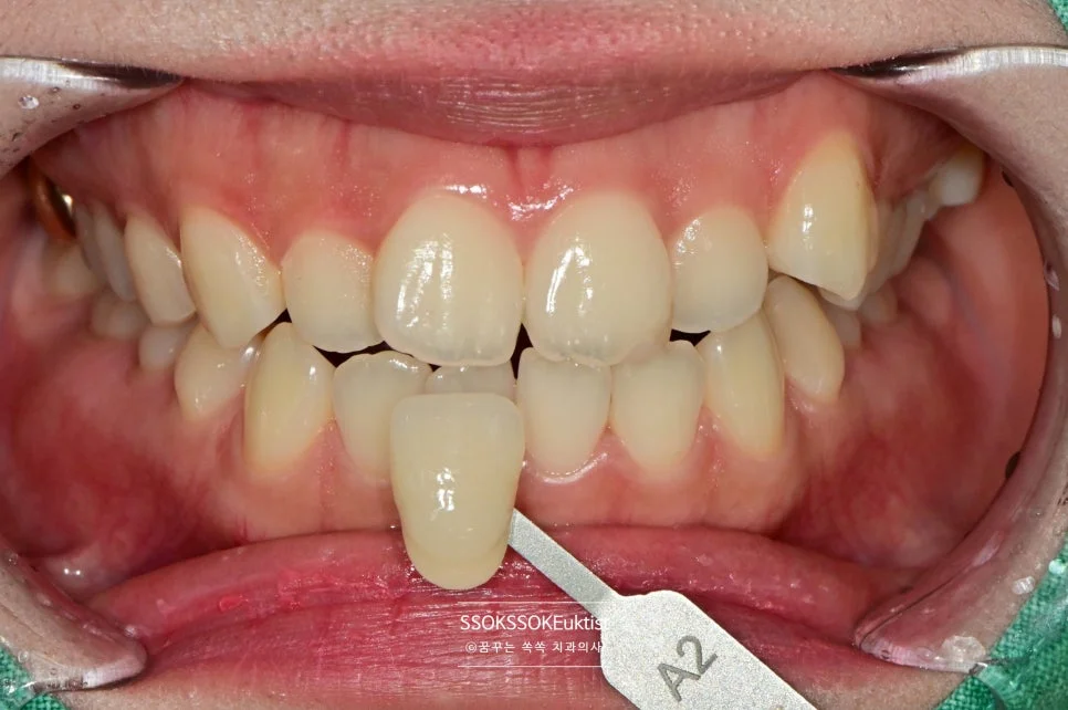 치아 미백 케이스2 치료 전 A2 쉐이드 가이드 비교