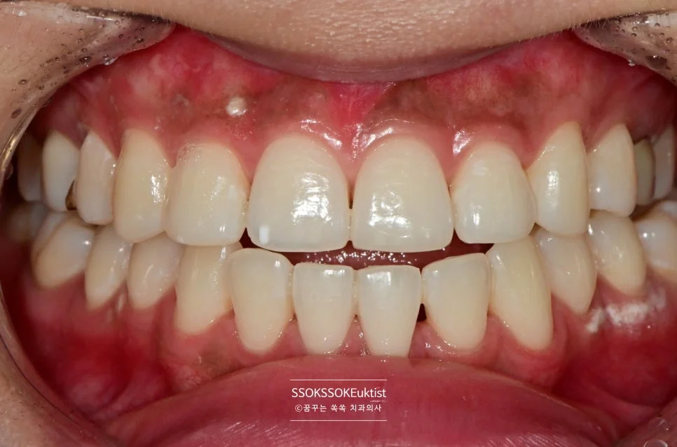 치아 미백 케이스3 미백 후 A1보다 밝은 결과