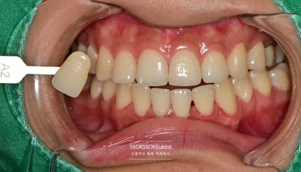 치아 미백 케이스3 치료 전 A2보다 밝은 상태