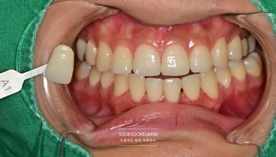 치아 미백 케이스3 A1과 유사한 톤 쉐이드 비교