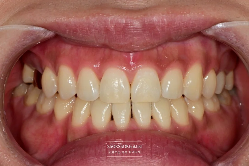 치아 미백 케이스4 미백 후 A1보다 밝은 결과