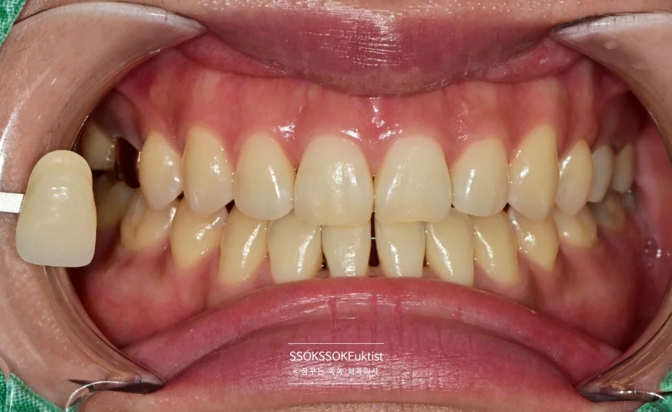 치아 미백 케이스4 치료 전 A2 쉐이드 비교