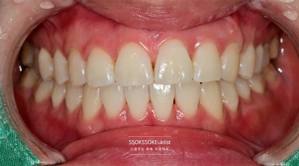치아 미백 케이스5 미백 후 B1보다 밝은 결과