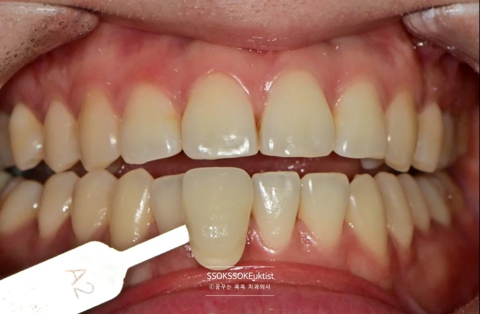 치아 미백 케이스5 치료 전 A2보다 밝은 상태