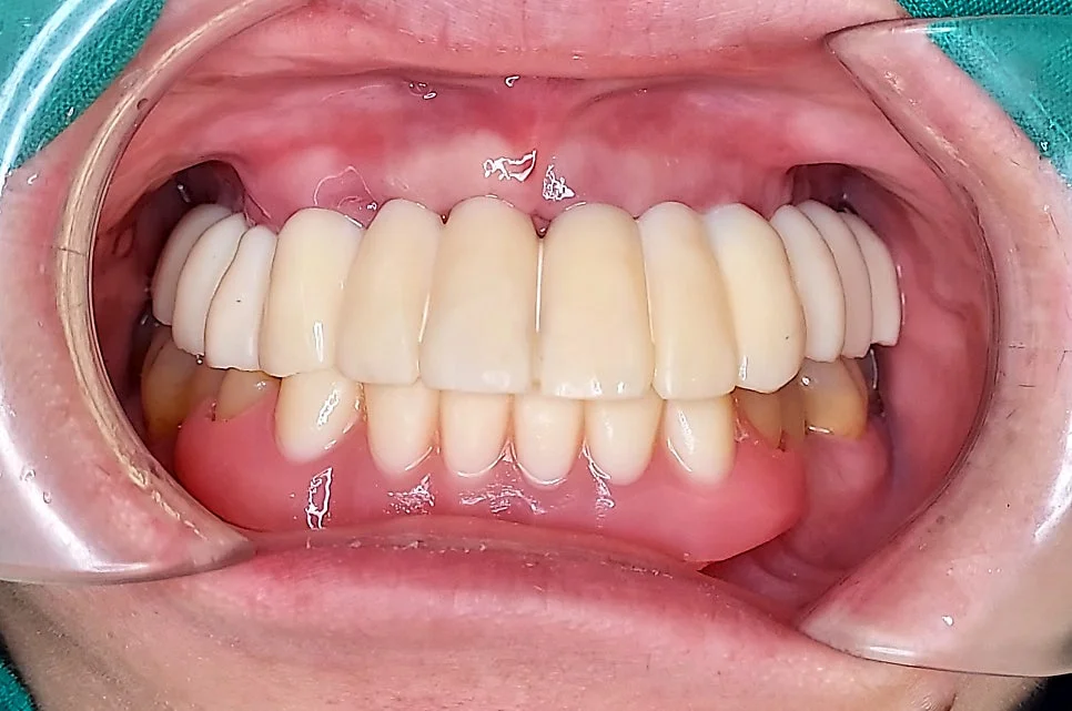 임시 보철 장착 구강 전면