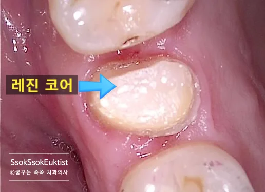 신경치료 완료 후 임시 수복 상태 임상 사진