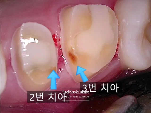 2번 3번 치아 충치 임상 사진