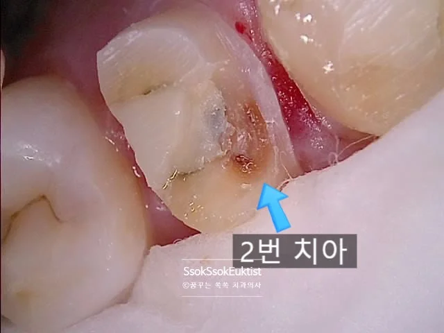 2번 치아 근접면 충치 확대 사진