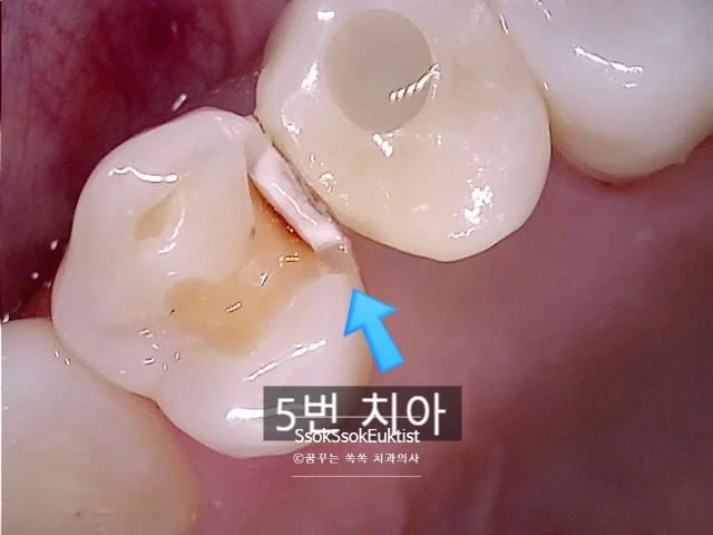 5번 치아 임플란트 인접 충치