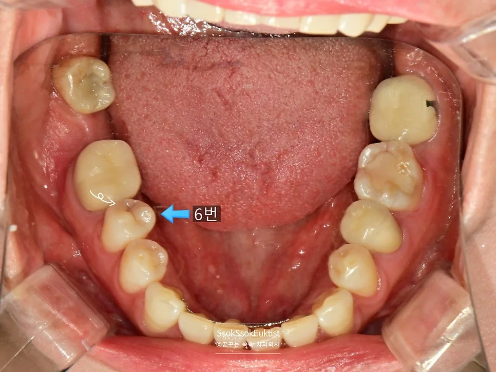 6번 치아 충치 위치 화살표 표시