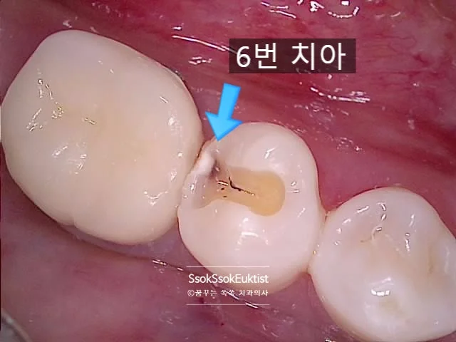 충치 치료 위한 치아 삭제 과정