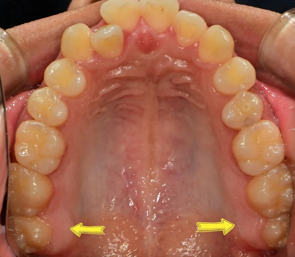 상악 교합면 사진 양측 사랑니 화살표 표시