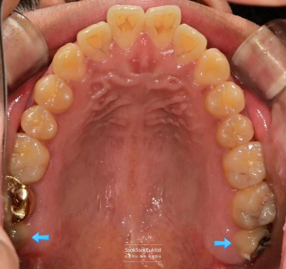 상악 구강 사진 사랑니 맹출 상태