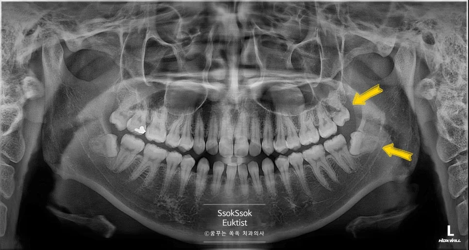 상악 왼쪽 사랑니 구강 내 임상 사진