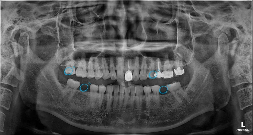 찌릿한 통증 상악 어금니 구강 내 사진