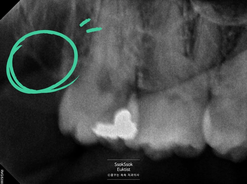 오른쪽 위 사랑니 완전 발치 결과