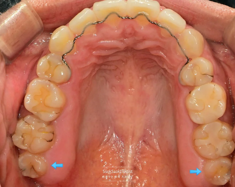 상악 사랑니 방사선 진단