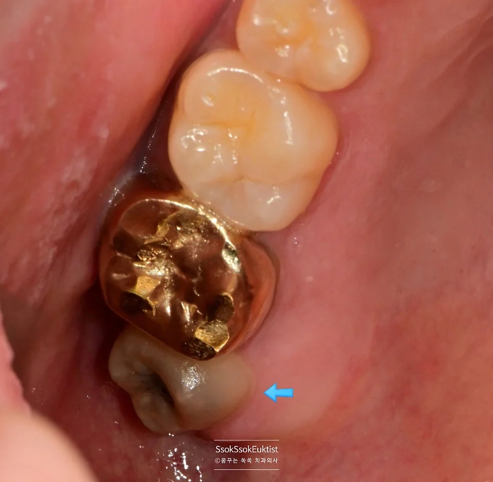 위 사랑니 충치 협측 근접 사진