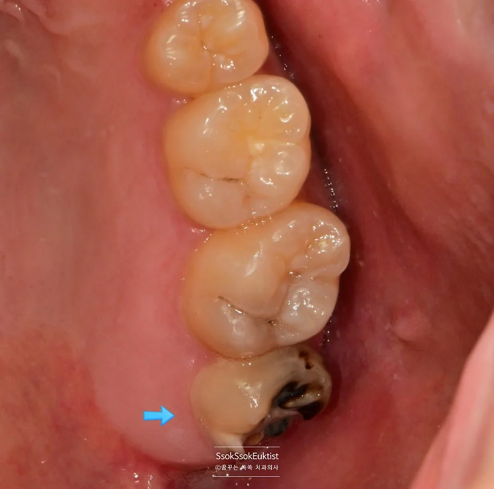 위 사랑니 충치 교합면 근접 사진