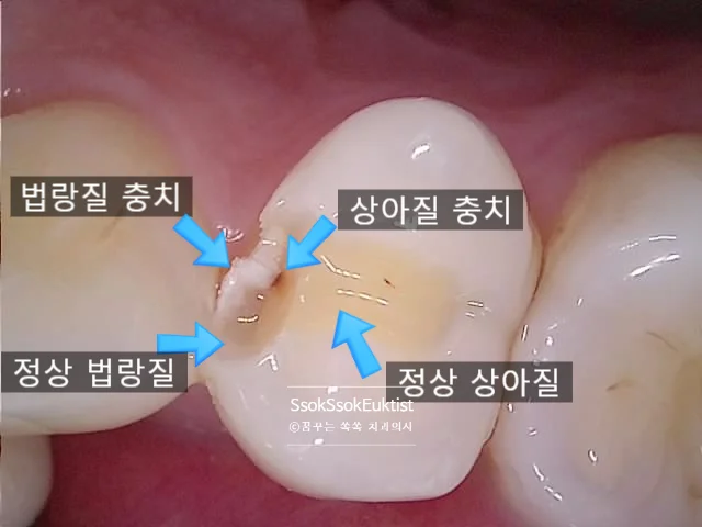 충치 제거 후 법랑질 충치가 하얀색인 것을 확인할 수 있는 모습