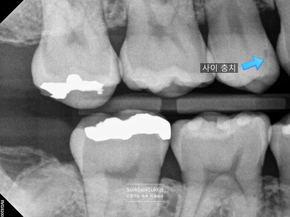 교익 방사선 사진 치아 사이 충치 확인 X-ray